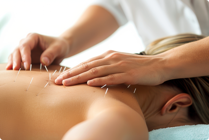 Acupuncture
