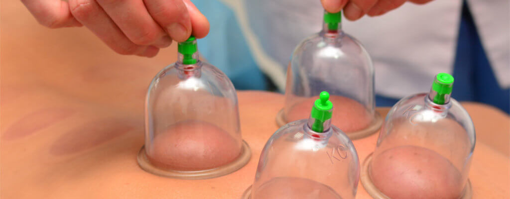 cupping imotion physical therapy